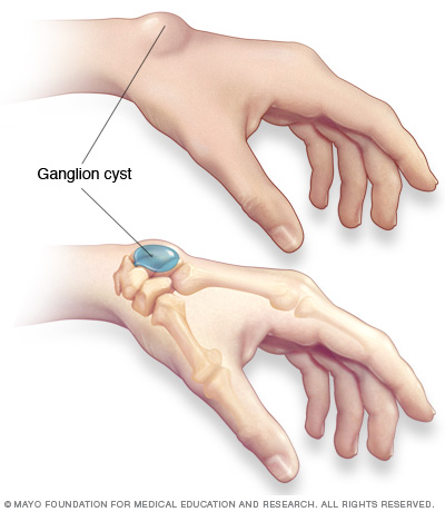 ganglion cyst.jpg